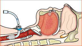 tracheostomy illustration